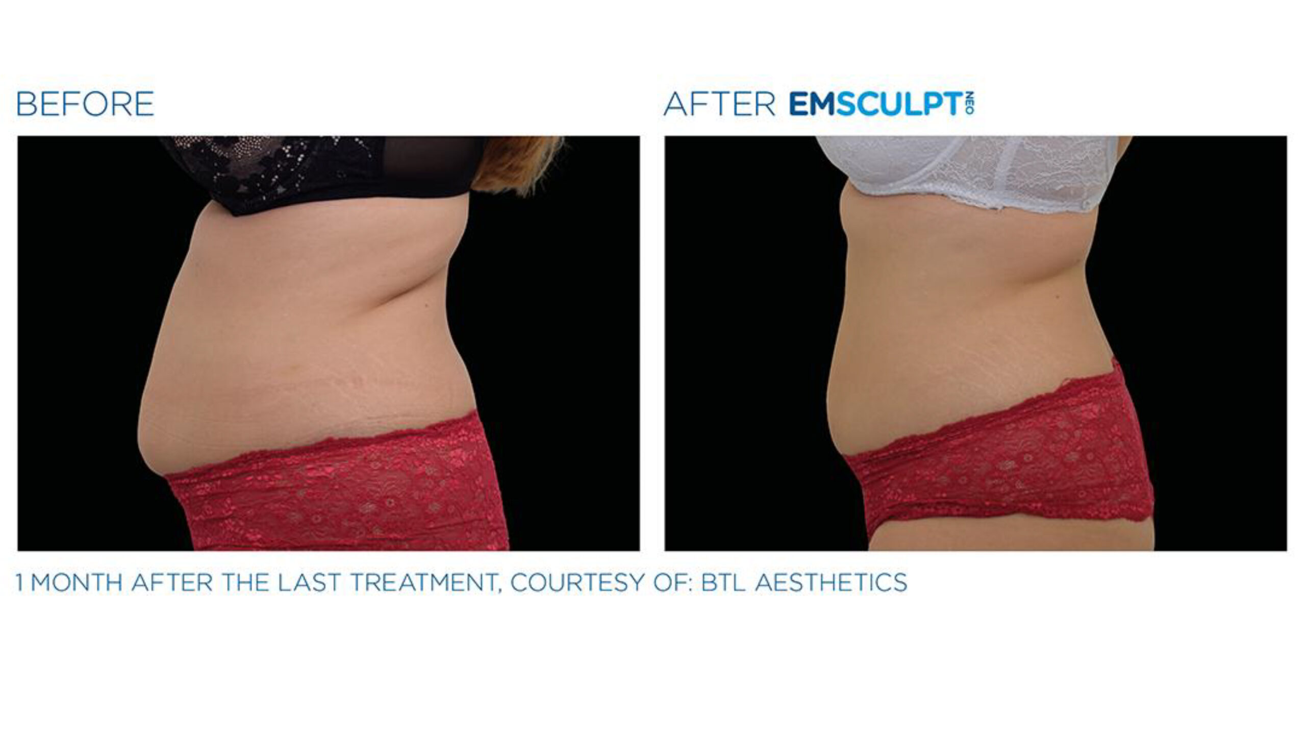 Top Form Care - EMSCULPT NEO 10