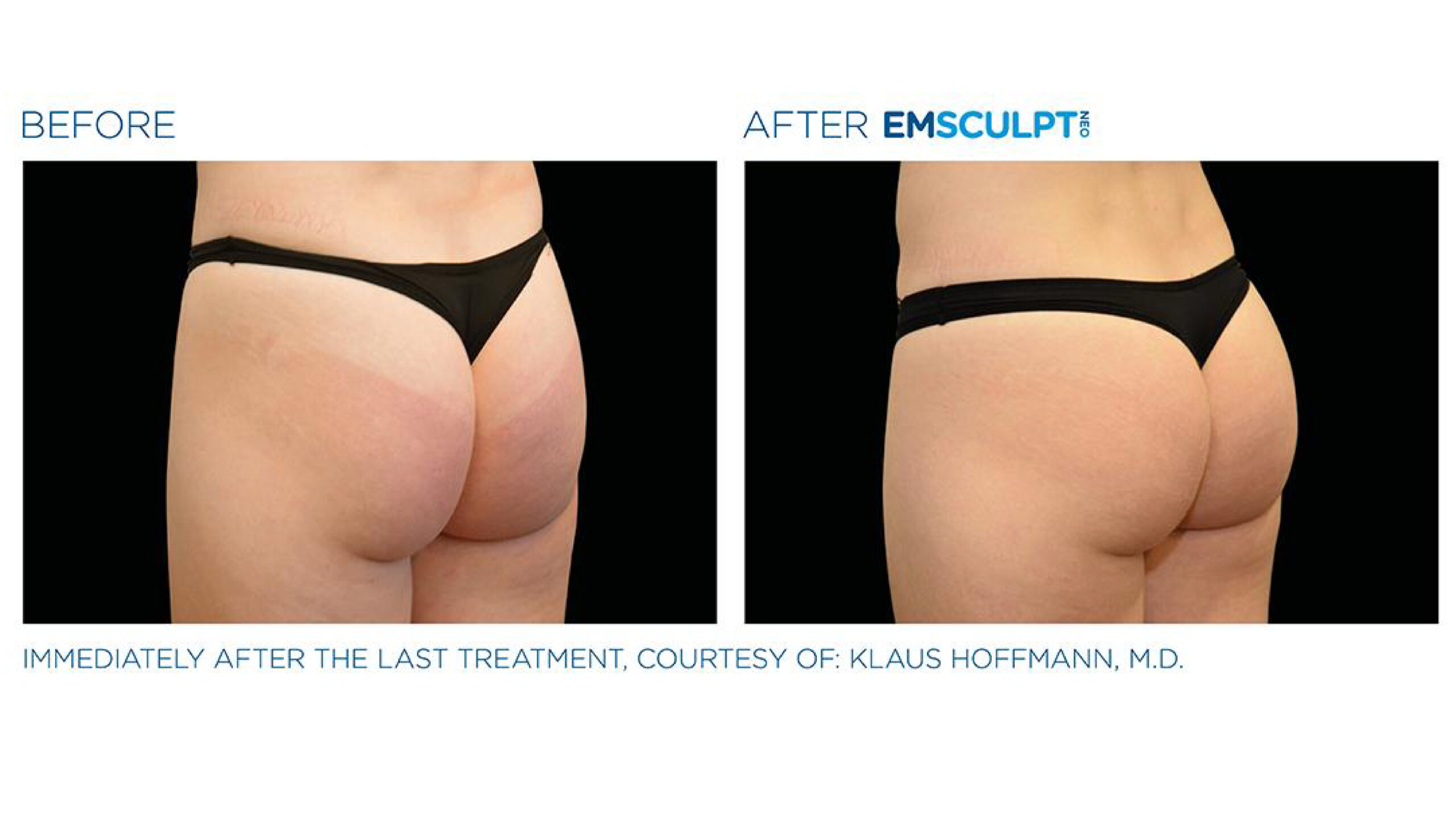 Top Form Care - EMSCULPT NEO 12